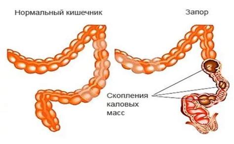 th?q=атонический+запор+что+делать+атония+кишечника+лечение+форум