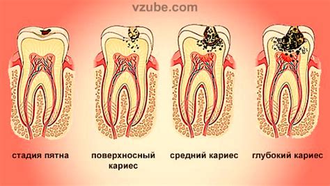 th?q=кариес+в+зубе+присн