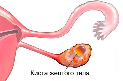 th?q=может+ли+болеть+киста+желтого+тела+киста+эндоцервикса+до+5+мм