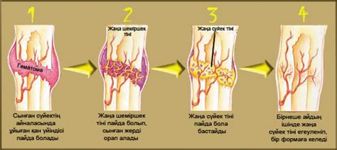 th?q=сүйек+сынықтары+жөнінде+түсінік+сынған+сүйек+неше+күнде+бітеді