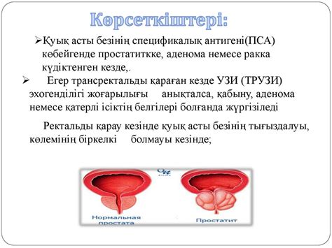 th?q=қуық+асты+безін+саусақпен+тексеру+куык+асты+бези+деген+не