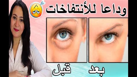 علاج انتفاخ تحت العين من الصيدلية، هناك العديد من الأسباب ل ظهور العين منتفخة و ذلك من الأسفل، و من المحتمل علاج هذا الانتفاخ بشكل طبي 