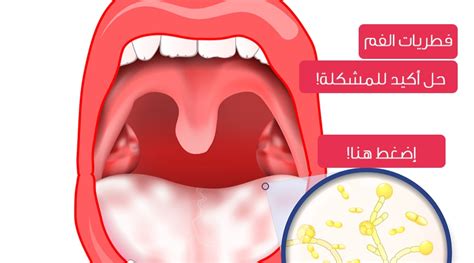 علاج ملوحة الفم