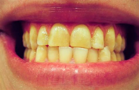 ما هي أسباب اصفرار الأسنان 