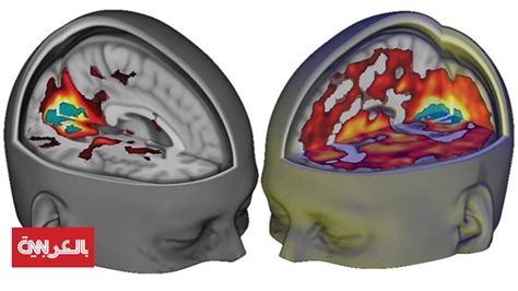 هذا ما تبدو عليه أدمغتنا عند تعاطي مخدّر "LSD" - CNN Arabic