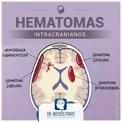 ศัพท์แพทย์คำว่า Hematoma, Intracranial ความหมายคือ …