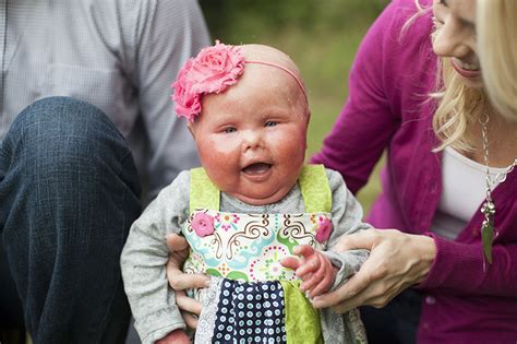 ‘Baby Brenna’ is now a growing girl SIU School of Medicine