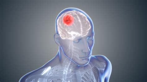 ‘Exciting’ glioblastoma study: Researchers create virus that effectively targets brain cancer