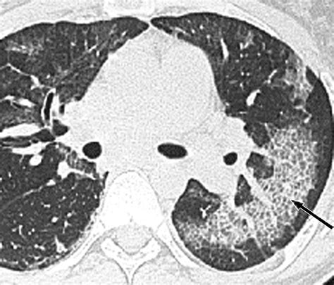 “Crazy-Paving” Pattern at Thin-Section CT of the ... - RadioGraphics