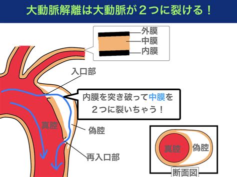 「急性大動脈解離」の症状・原因はご存知ですか？医師が監修！