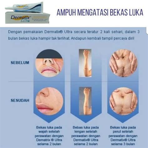 【ևդዖха】 Lengkap perbedaan dermatix ultra asli dan palsu yang wajib