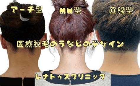 うなじの脱毛方法と理想の形について 新宿の医療脱毛ドクター松井クリニック