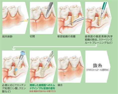 エムドゲインによる歯槽骨の再生｜小机歯科医院｜神奈川県横浜 …