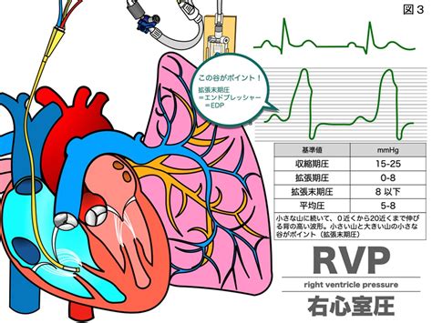 スワンガンツカテーテル｜スワンガンツカテーテルの適応・目的 …