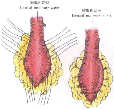 下列哪项属于血管介入（）A.冠脉搭桥术B.脾动脉栓塞术C.经皮腰穿刺D.PTCDE.经皮椎间盘 …