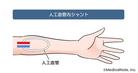 人工血管内シャント造設術後の上肢浮腫に対する弾性筒状サ …