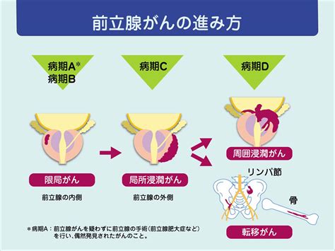 前立腺がんと多発性骨髄腫の骨転移の特徴と対策：がんナビ