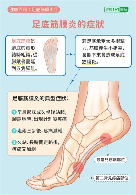 告别足痛困扰：治疗足底筋膜炎的中文建议