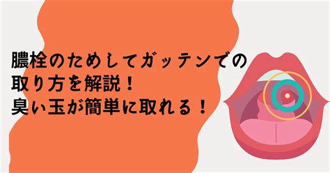 喉の奥にできる白い塊「膿栓」。なぜできるの？害はないの？