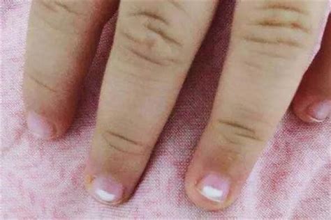 宝宝指甲上有白点是什么原因