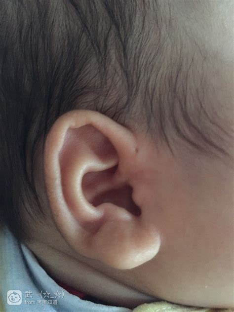 宝宝耳朵上起小疙瘩