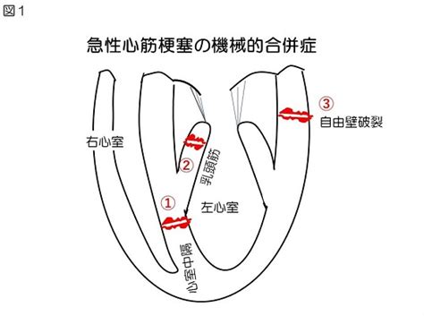 急性心筋梗塞後のoozing typeの左室自由壁破裂にIABPが 循 …