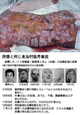 日本东海村核临界事故 治疗核辐射83天的记录-千里眼视频-搜狐视频