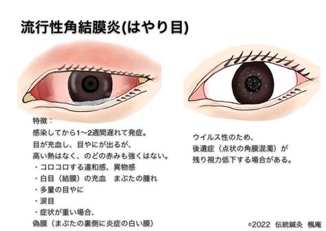 流行性角結膜炎(ウイルス性結膜炎)｜おながファミリー眼科 戸塚 …