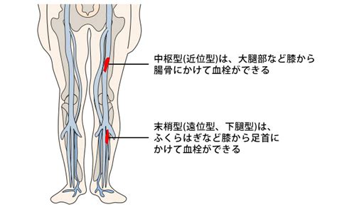 深部静脈血栓症(DVT) (しんぶじょうみゃくけっせんしょう) 済生会