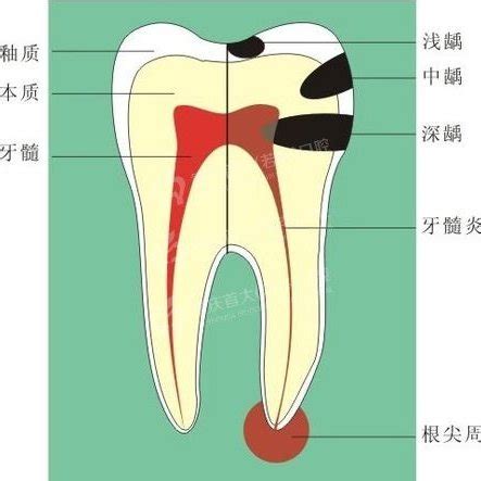 牙髓炎_360百科 - SO