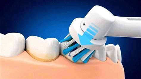 电动牙刷会损害牙龈吗？