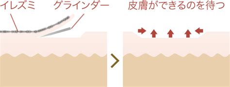皮膚を削る 削皮術でタトゥーを除去する方法のすべて