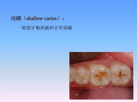 继发龋的英文,口腔内科看什么病 - 词典网