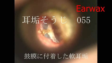 耳の垢の取り方は？