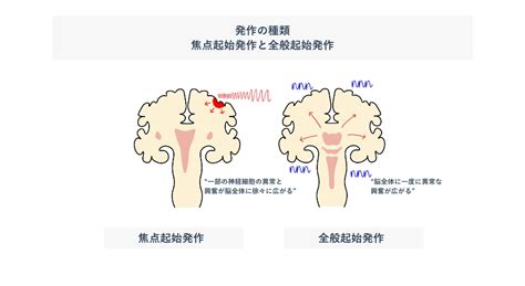 脳内出血、てんかん発作の原因にもなる遺伝性の病気とは メ …