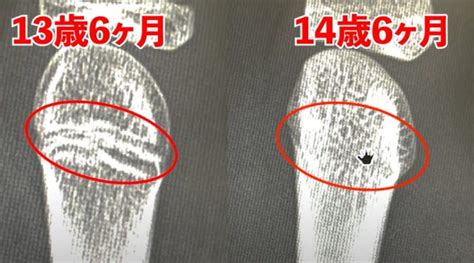 骨端線を確認する方法。閉鎖時期はいつまで？まだ身長は伸び …