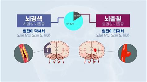 과체중이 치명적인 뇌경색 발생 - kg m2