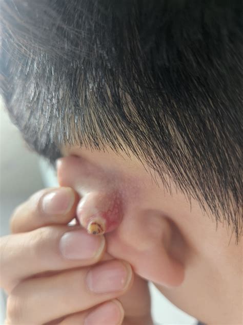 귀 뒤 피지낭종