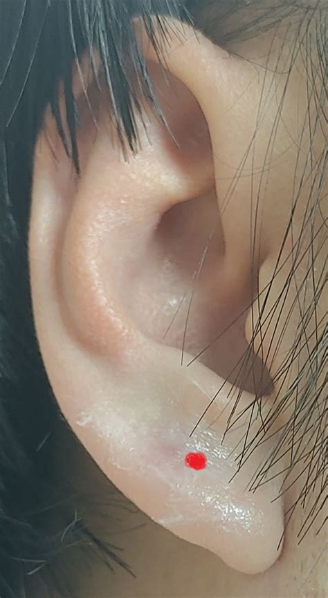 귀 표피낭종
