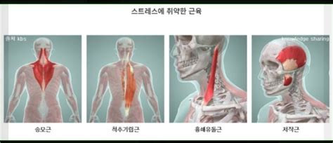 근육의 긴장띠, 스트레스 근육