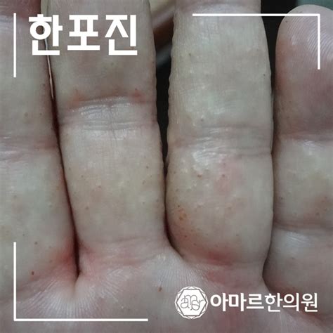 네이버 블로그>손등 손바닥 수포 가려움 두드러기 원인 및 치료