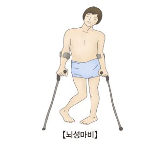 뇌성 마비 질환백과 의료정보 서울아산병원 - 뇌성 마비 증상