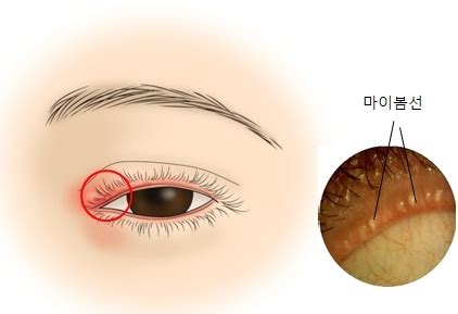 눈꺼풀 염증