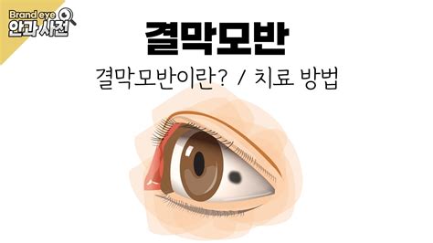 눈질환과치료 공 안과 - 결막 낭