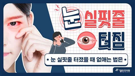 눈 실핏줄 터짐 눈충혈 원인과 증상 관리법 체크하세요