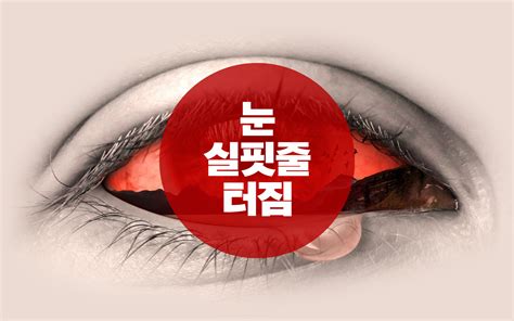 눈 실핏줄 터짐 원인 및 치료방법 눈 핏줄 터짐 결막하출혈 >눈
