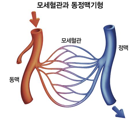 동정맥 기형