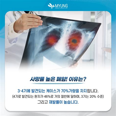 무료 폐암 검사