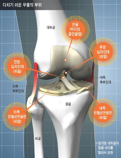 무릎십자인대 손상 회복기간 건강Q A 하이닥 - 인대 파열 회복
