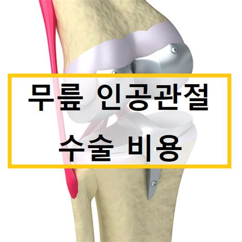 무릎 연골 수술 비용